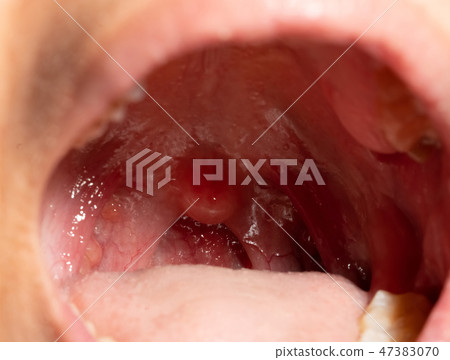 Sore throat with throat swollen. Open mouth Sore throat with throat swollen. Open mouth 47383070