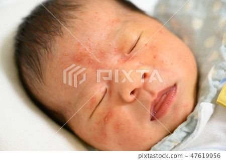 Newborn eczema Newborn eczema 47619956