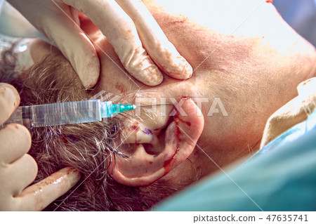 Chin reduction augmentation double chin removal plastic surgery cosmetic operation concept. Chin Chin reduction augmentation double chin removal plastic surgery cosmetic operation concept. Chin 47635741
