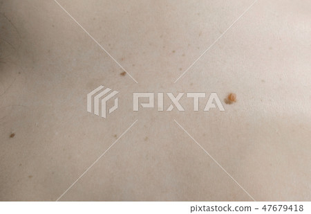 Woman's white skin with moles. View top. Close up back. Woman's white skin with moles. View top. Close up back. 47679418