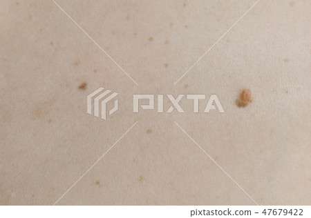 Woman's white skin with moles. View top. Close up back. Woman's white skin with moles. View top. Close up back. 47679422