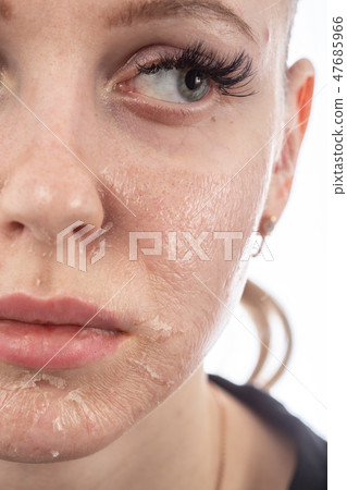 skin after peeling skin after peeling 47685966