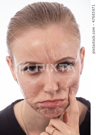skin after peeling skin after peeling 47685971