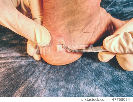 Medical treatment of skin, abrasions on the heel. Medical treatment of skin, abrasions on the heel. 47768054