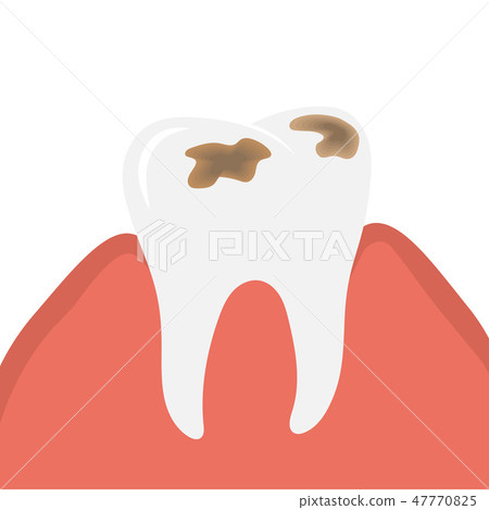 Decay and destroy tooth or dental caries Decay and destroy tooth or dental caries 47770825