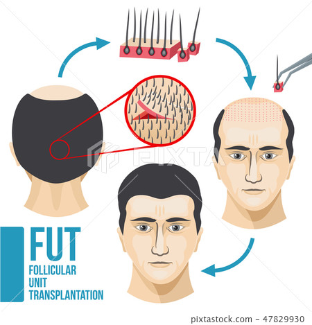 Male hair loss treatment medical vector infographic Male hair loss treatment medical vector infographic 47829930