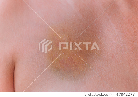 real huge yellow, red and blue bruise at breast 47842278