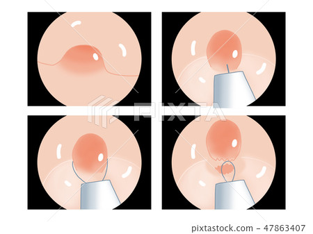 結腸鏡檢查EMR圈套器插圖 結腸鏡檢查EMR圈套器插圖 47863407