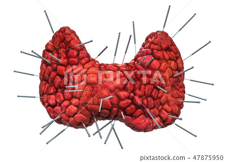 Human thyroid with acupuncture needles 47875950