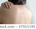Woman with dermatology skin Dermatologist  47915195