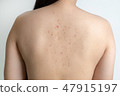 Woman with dermatology skin Dermatologist  47915197
