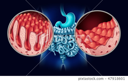 Celiac Coeliac Disease 47918601
