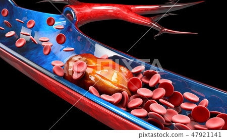 Deep Vein Thrombosis or Blood Clots. Embolism. 47921141