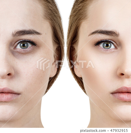 Woman with bruises under eyes before and after cosmetic treatment. 47932915