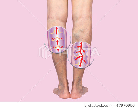 Varicose veins on a female senior legs. The structure of normal and varicose veins. 47970996