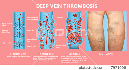 Deep Vein Thrombosis or Blood Clots. Embolus. 47971006