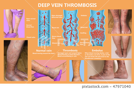 Economy class syndrome mechanism, deep vein thrombosis or DVT, Pulmonary Embolism, coronary 47971040