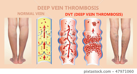Deep Vein Thrombosis or Blood Clots. Embolus. Deep Vein Thrombosis or Blood Clots. Embolus. 47971060