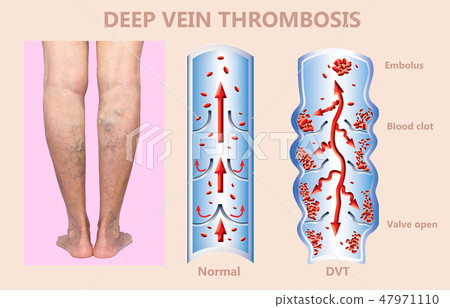Deep Vein Thrombosis or Blood Clots. Embolus. 47971110