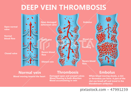 thrombosis. From Normal blood flow to Blood clot formation 47991239