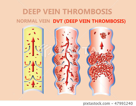 thrombosis. From Normal blood flow to Blood clot formation 47991240