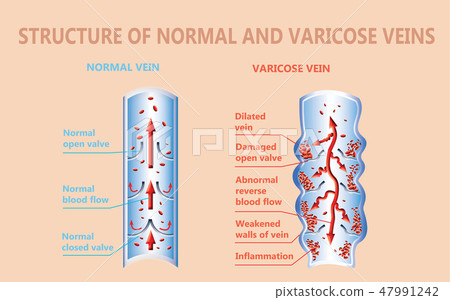 Varicose veins on a female senior legs. The structure of normal and varicose veins. 47991242