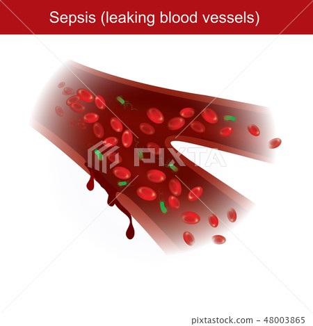 When the body has immune response to bacterial When the body has immune response to bacterial 48003865