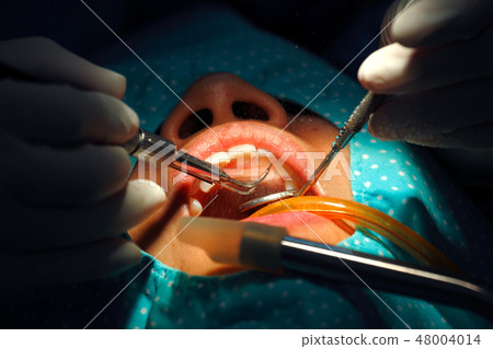 Dental scaling 48004014