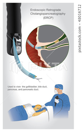 Endoscopic retrograde cholangiopancreatography 48016712