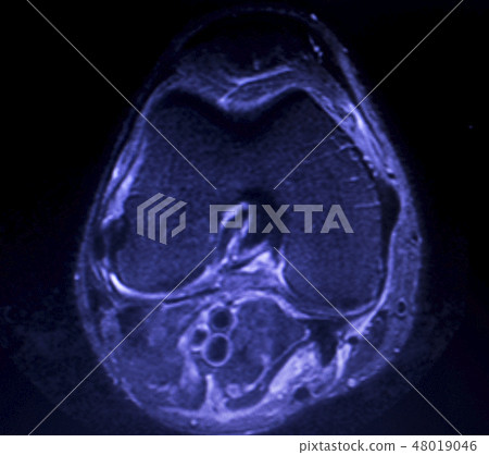 MRI knee meniscus tear scan 48019046