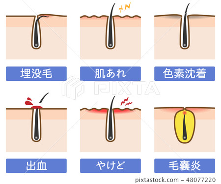 脱毛皮肤问题的插图 如埋藏的毛发和毛囊炎 图库插图