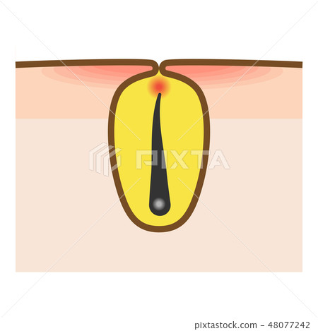 多餘的頭髮護理·脫髮麻煩毛囊炎(毛囊炎)的插圖 多餘的頭髮護理·脫髮麻煩毛囊炎(毛囊炎)的插圖 48077242