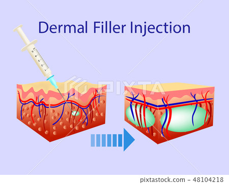 Vector illustration with cosmetic filler or Dermal fillers on blue background 48104218