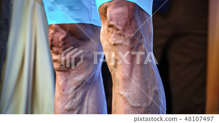 Cyclist legs with varicose and protruded veins, front view Cyclist legs with varicose and protruded veins, front view 48107497