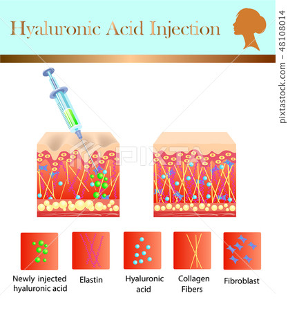 hyaluronic acid injection, before and affect  48108014