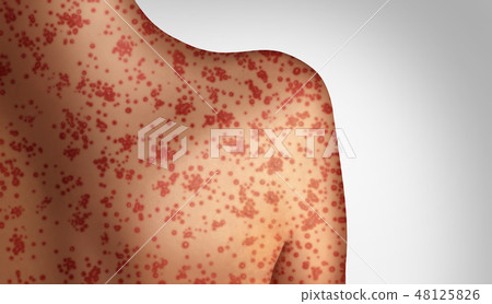 Measles Concept 48125826