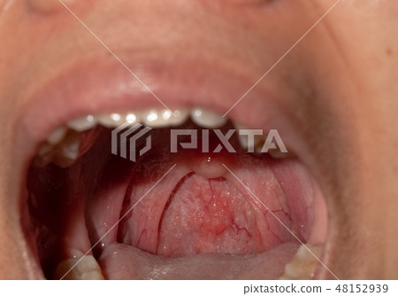 Sore throat with throat swollen. Open mouth. 48152939