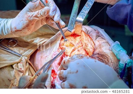 Facial plastic surgery operation. Face lift surgery. Surgeon separated the skin from the patient's Facial plastic surgery operation. Face lift surgery. Surgeon separated the skin from the patient's 48165281