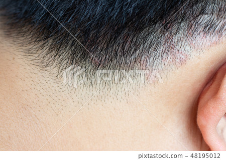 Closed up of ringworm (tinea) on head of asian man Closed up of ringworm (tinea) on head of asian man 48195012