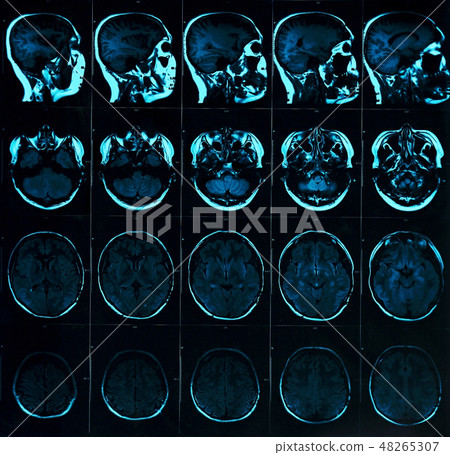 Magnetic resonance scan of the brain with skull 48265307