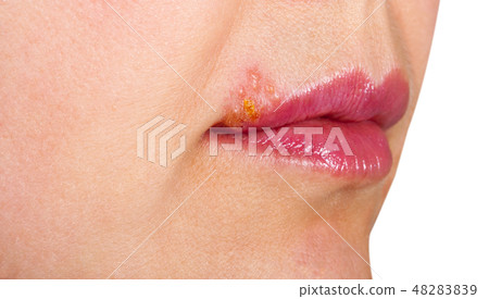 Herpes on the lip close up macro 48283839