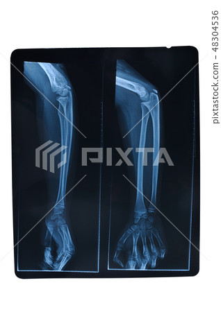 x-ray of forearm on white background 48304536
