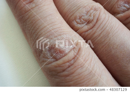 Close up of hands with dry cracked skin. Close up of hands with dry cracked skin. 48307129