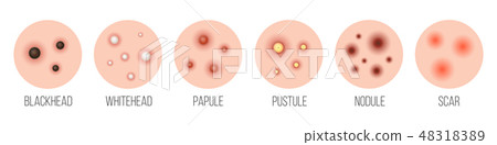 Creative vector illustration types of acne, pimples, skin pores, blackhead, whitehead, scar Creative vector illustration types of acne, pimples, skin pores, blackhead, whitehead, scar 48318389