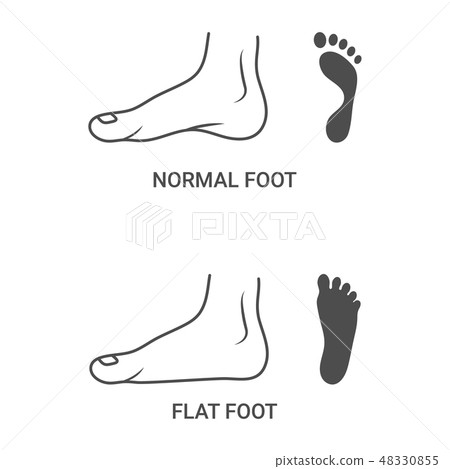 Foot Pathologies, Normal, Flat Foot Isolated On A White Background. Vector Illustration. 48330855