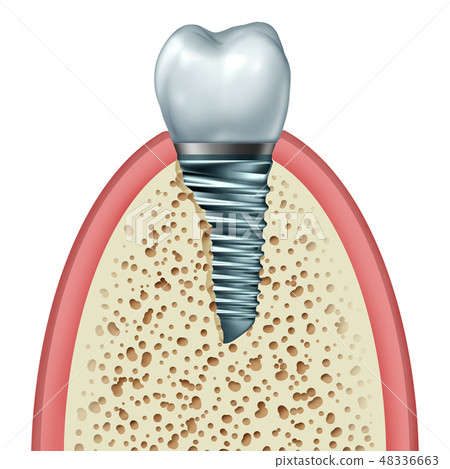 Tooth Implant Tooth Implant 48336663