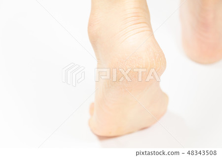 中老年女性腳跟裂紋角化病 中老年女性腳跟裂紋角化病 48343508