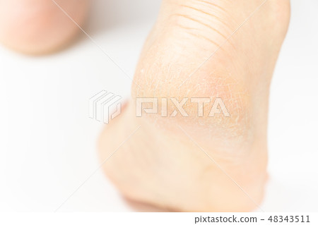 中老年女性腳跟裂紋角化病 48343511