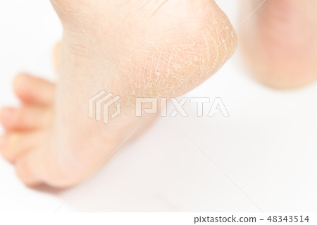 中老年女性腳跟裂紋角化病 中老年女性腳跟裂紋角化病 48343514