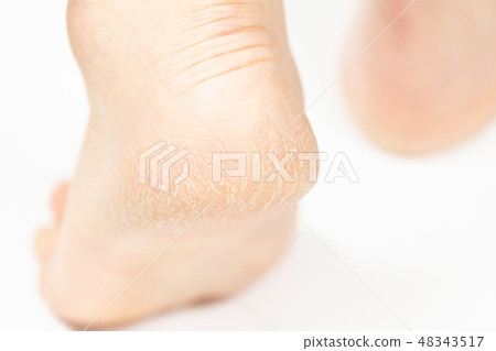 中老年女性腳跟裂紋角化病 48343517